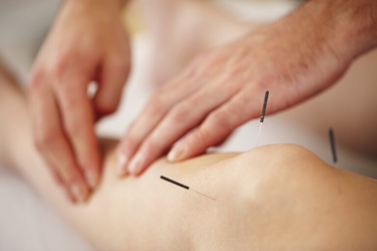 Closeup of acupuncture needles with man lightly massaging woman's leg